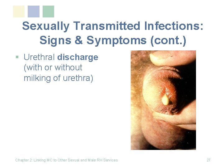 Sexually Transmitted Infections: Signs & Symptoms (cont. ) § Urethral discharge (with or without