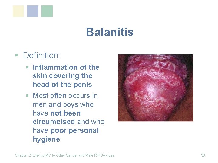 Balanitis § Definition: § Inflammation of the skin covering the head of the penis