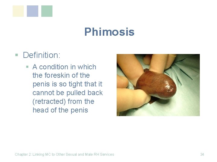 Phimosis § Definition: § A condition in which the foreskin of the penis is