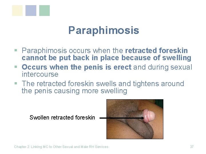 Paraphimosis § Paraphimosis occurs when the retracted foreskin cannot be put back in place