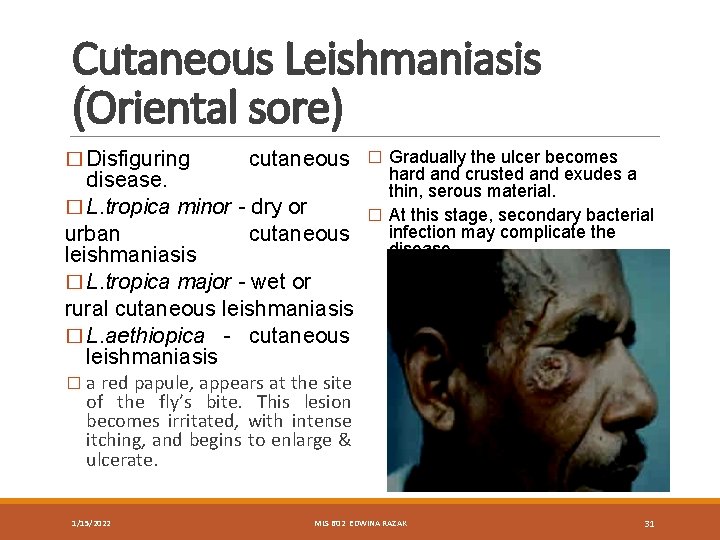 Cutaneous Leishmaniasis (Oriental sore) � Disfiguring cutaneous disease. � L. tropica minor - dry