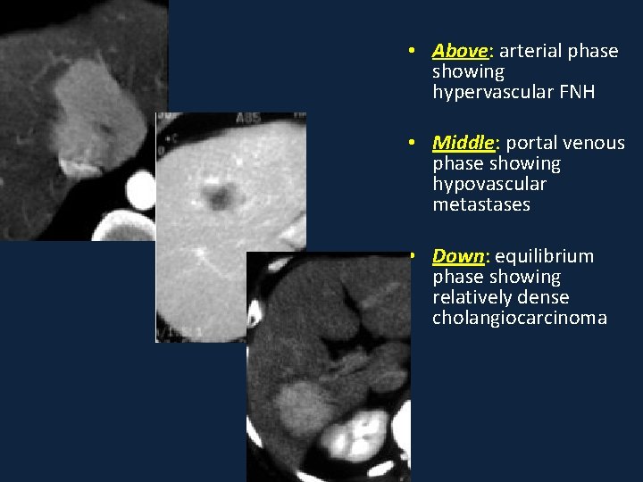  • Above: arterial phase showing hypervascular FNH • Middle: portal venous phase showing