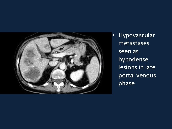  • Hypovascular metastases seen as hypodense lesions in late portal venous phase 