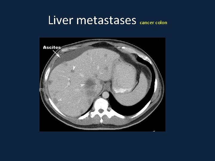 Liver metastases cancer colon 