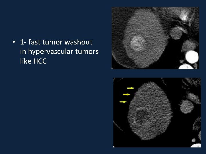  • 1 - fast tumor washout in hypervascular tumors like HCC 