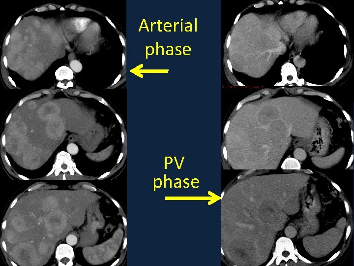 Arterial phase PV phase 