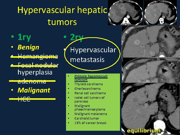 Hypervascular hepatic tumors • 1 ry • 2 ry • Benign • Hypervascular •