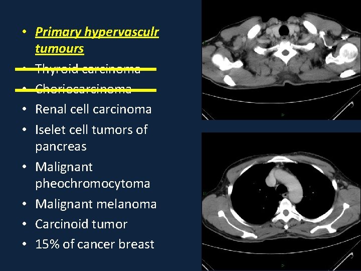  • Primary hypervasculr tumours • Thyroid carcinoma • Choriocarcinoma • Renal cell carcinoma