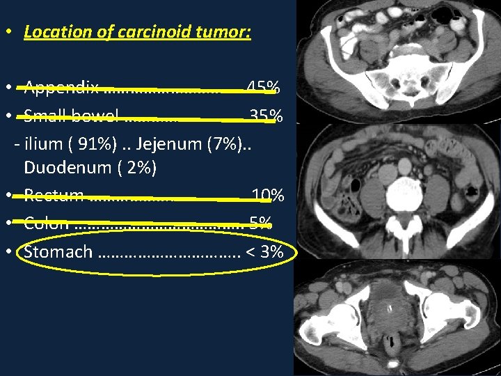  • Location of carcinoid tumor: • Appendix ……………. 45% • Small bowel ……………