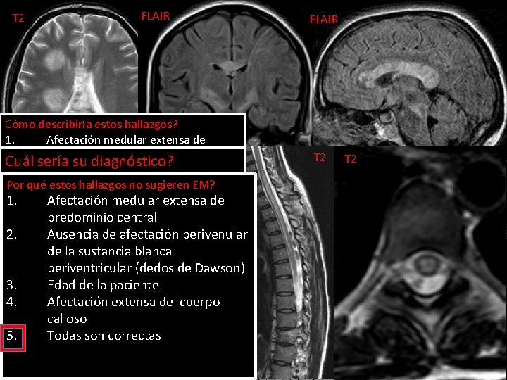 T 2 FLAIR Cómo describiría estos hallazgos? 1. Afectación medular extensa de predominio posterior