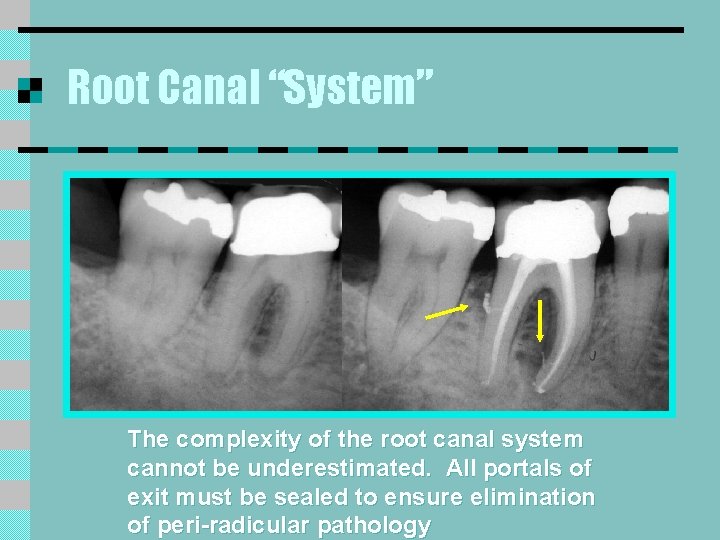 Root Canal “System” The complexity of the root canal system cannot be underestimated. All
