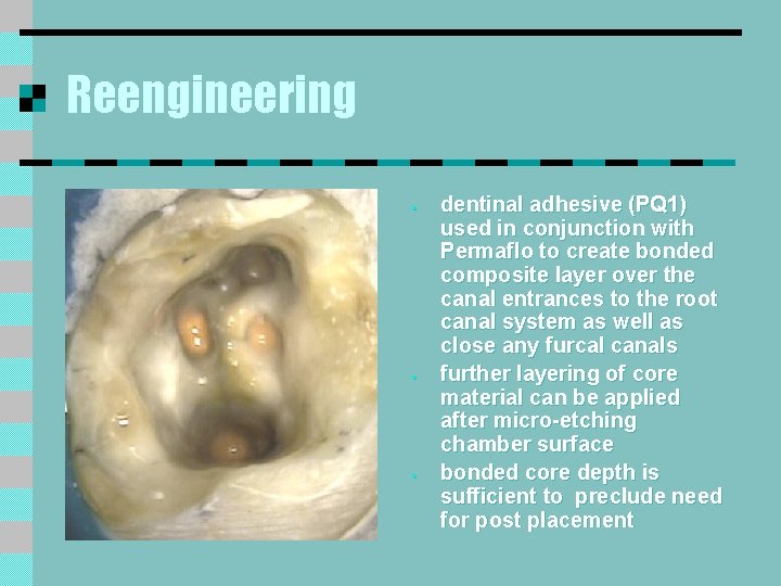 Reengineering § § § dentinal adhesive (PQ 1) used in conjunction with Permaflo to