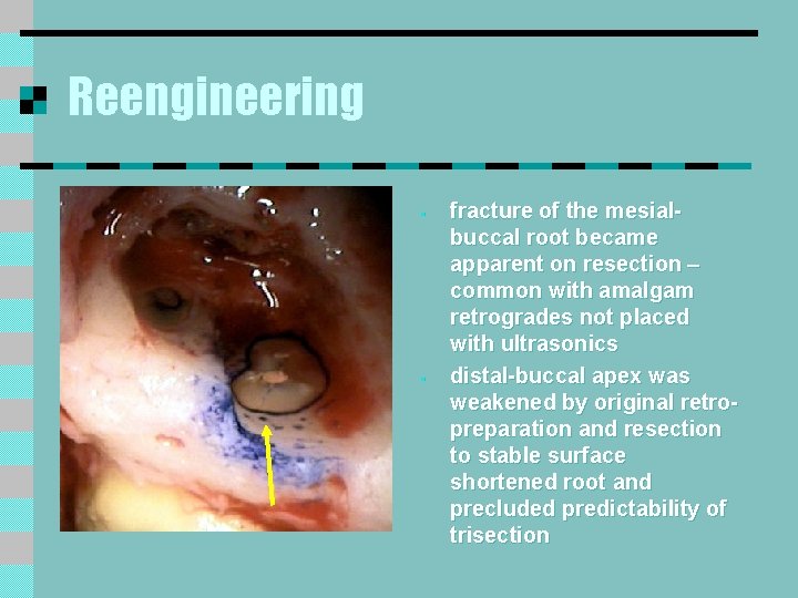 Reengineering § § fracture of the mesialbuccal root became apparent on resection – common