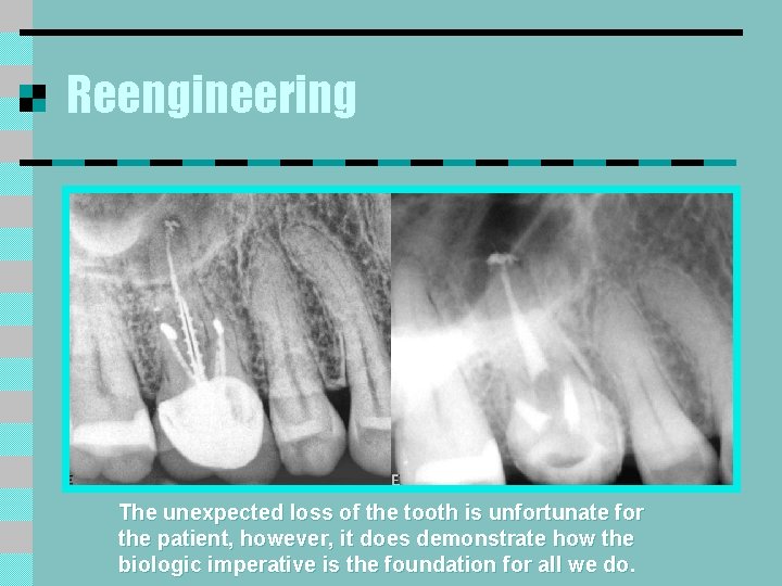 Reengineering The unexpected loss of the tooth is unfortunate for the patient, however, it