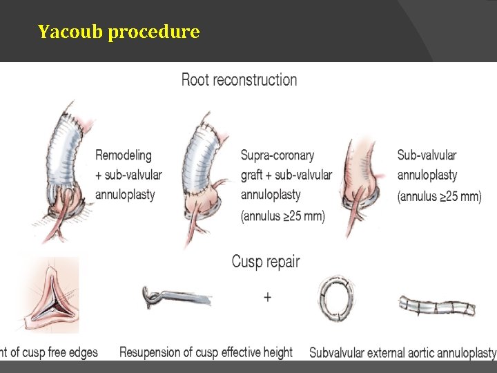 Yacoub procedure 