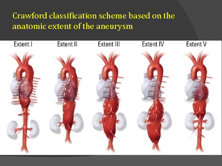Crawford classification scheme based on the anatomic extent of the aneurysm 