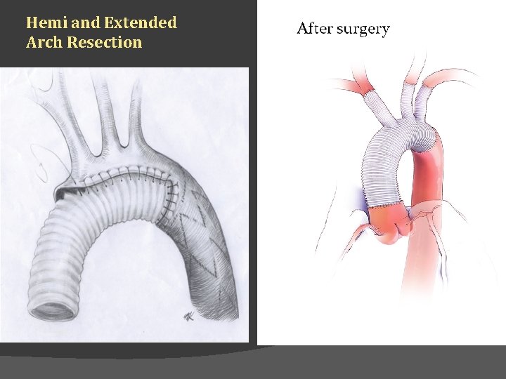 Hemi and Extended Arch Resection 