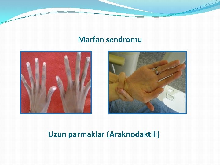 Marfan sendromu Uzun parmaklar (Araknodaktili) Marfan sendromu Uzun parmaklar (Araknodaktili)