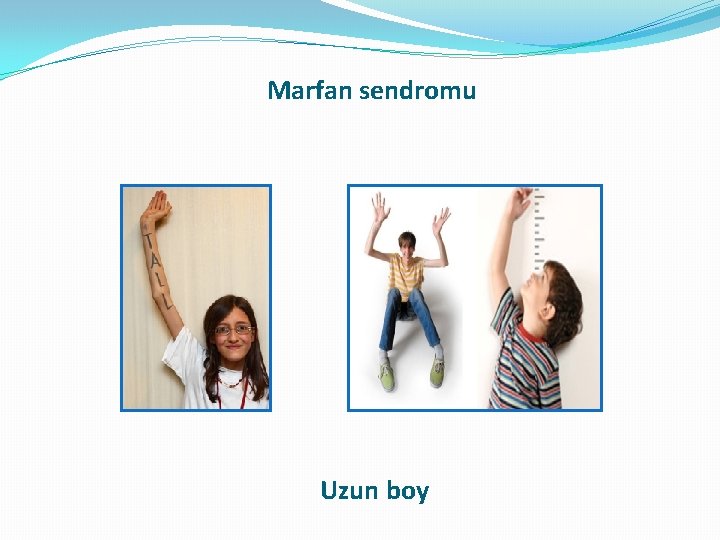 Marfan sendromu Uzun boy Marfan sendromu Uzun boy