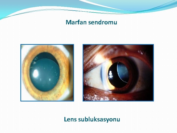 Marfan sendromu Lens subluksasyonu Marfan sendromu Lens subluksasyonu