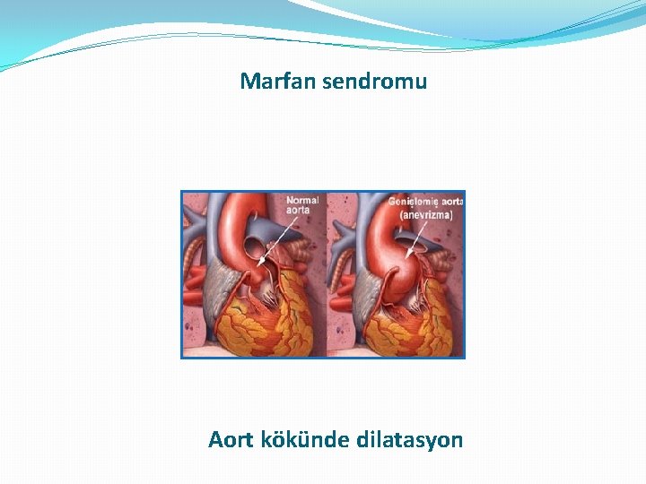 Marfan sendromu Aort kökünde dilatasyon Marfan sendromu Aort kökünde dilatasyon