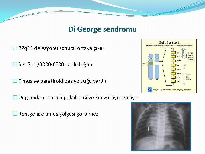 Di George sendromu � 22 q 11 delesyonu sonucu ortaya çıkar � Sıklığı: 1/3000 Di George sendromu � 22 q 11 delesyonu sonucu ortaya çıkar � Sıklığı: 1/3000