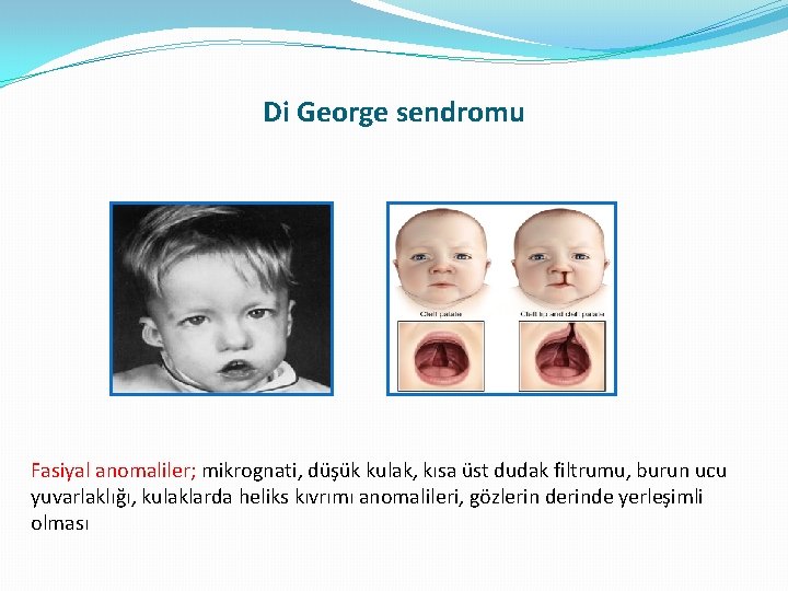 Di George sendromu Fasiyal anomaliler; mikrognati, düşük kulak, kısa üst dudak filtrumu, burun ucu Di George sendromu Fasiyal anomaliler; mikrognati, düşük kulak, kısa üst dudak filtrumu, burun ucu