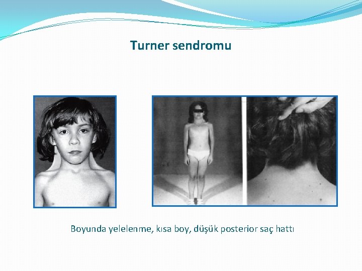 Turner sendromu Boyunda yelelenme, kısa boy, düşük posterior saç hattı Turner sendromu Boyunda yelelenme, kısa boy, düşük posterior saç hattı