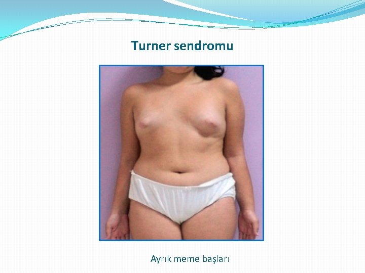 Turner sendromu Ayrık meme başları Turner sendromu Ayrık meme başları