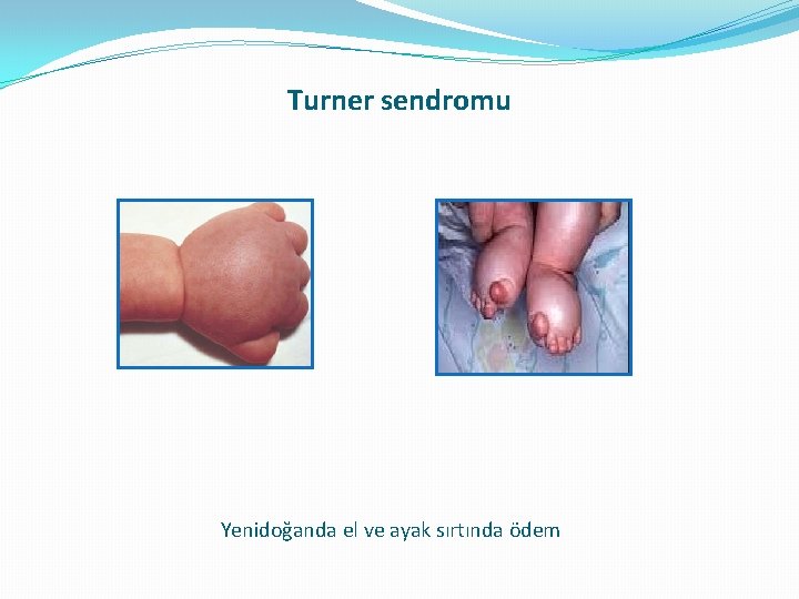 Turner sendromu Yenidoğanda el ve ayak sırtında ödem Turner sendromu Yenidoğanda el ve ayak sırtında ödem