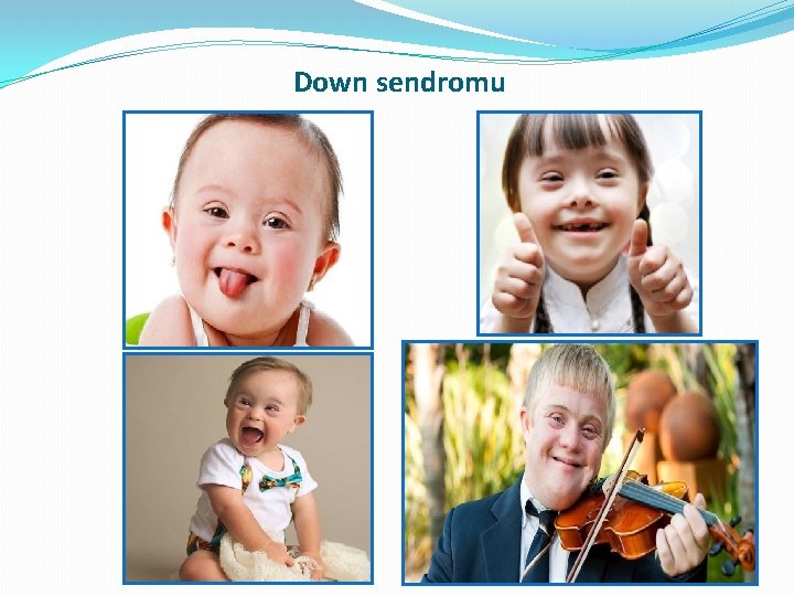 Down sendromu Down sendromu