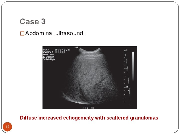 Case 3 � Abdominal ultrasound: Diffuse increased echogenicity with scattered granulomas 17 