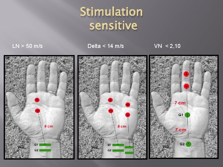 Stimulation sensitive LN > 50 m/s Delta < 14 m/s VN < 2, 10