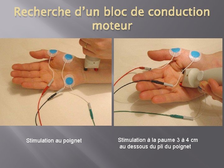 Recherche d’un bloc de conduction moteur Stimulation au poignet Stimulation à la paume 3