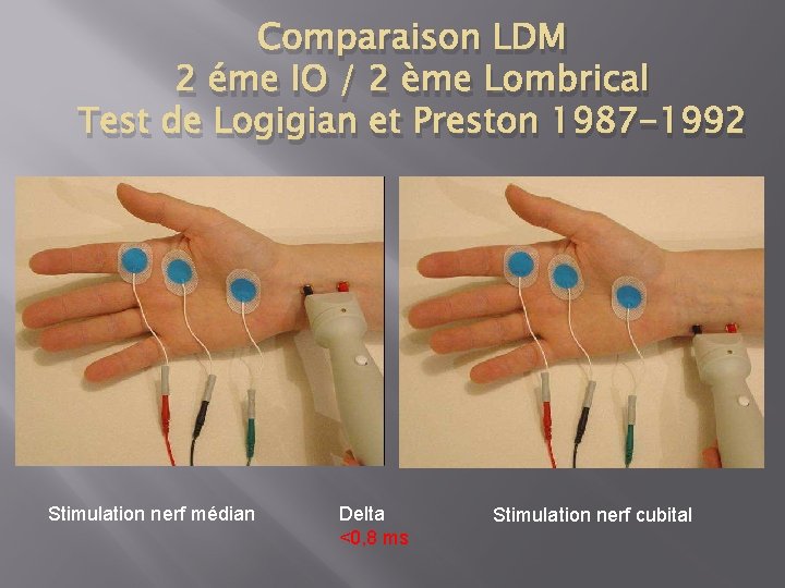 Comparaison LDM 2 éme IO / 2 ème Lombrical Test de Logigian et Preston