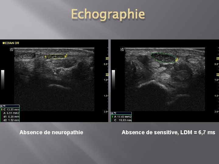 Echographie Absence de neuropathie Absence de sensitive, LDM = 6, 7 ms 