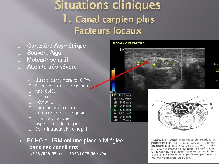 Situations cliniques 1. Canal carpien plus Facteurs locaux q q Caractère Asymétrique Souvent Aigu