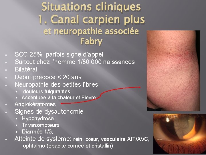 Situations cliniques 1. Canal carpien plus et neuropathie associée Fabry § § § SCC