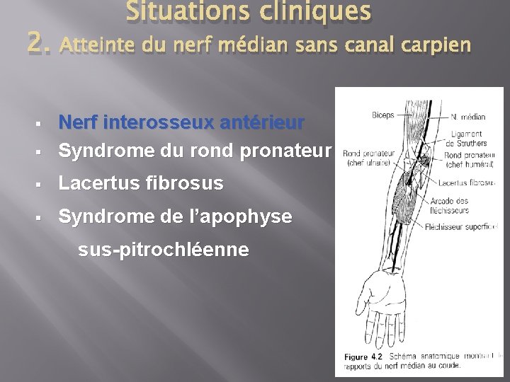 2. Situations cliniques Atteinte du nerf médian sans canal carpien § Nerf interosseux antérieur