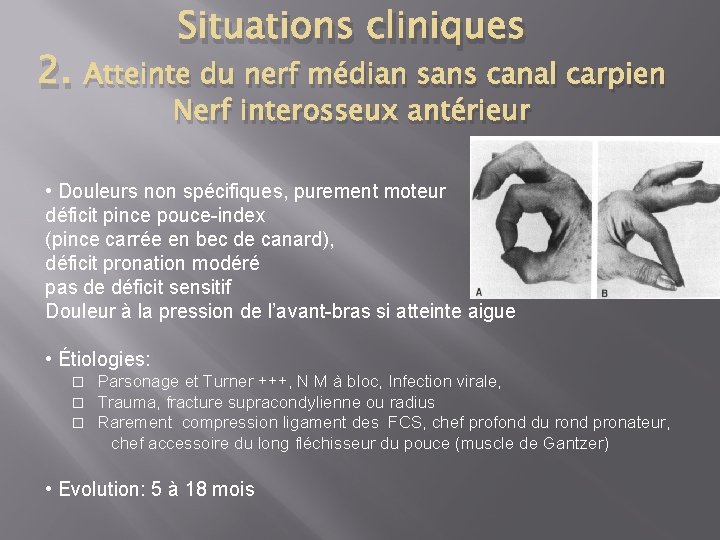 2. Situations cliniques Atteinte du nerf médian sans canal carpien Nerf interosseux antérieur •