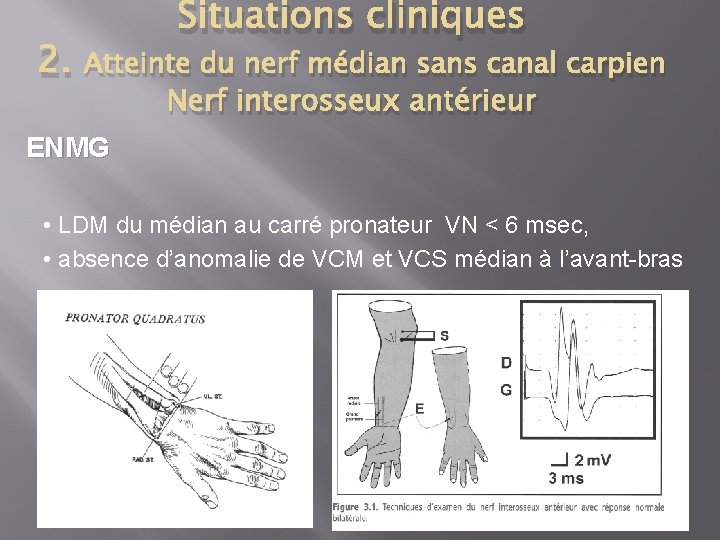 2. Situations cliniques Atteinte du nerf médian sans canal carpien Nerf interosseux antérieur ENMG