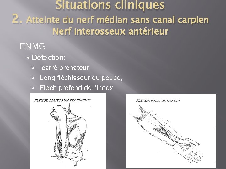 2. Situations cliniques Atteinte du nerf médian sans canal carpien Nerf interosseux antérieur ENMG