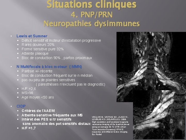 Situations cliniques 4. PNP/PRN Neuropathies dysimmunes § Lewis et Sumner § § § Déficit