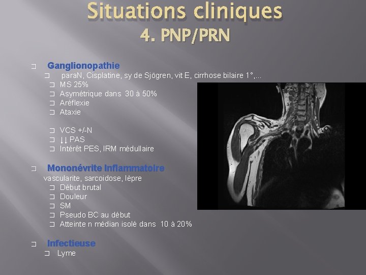 Situations cliniques 4. PNP/PRN � Ganglionopathie � � � � � para. N, Cisplatine,