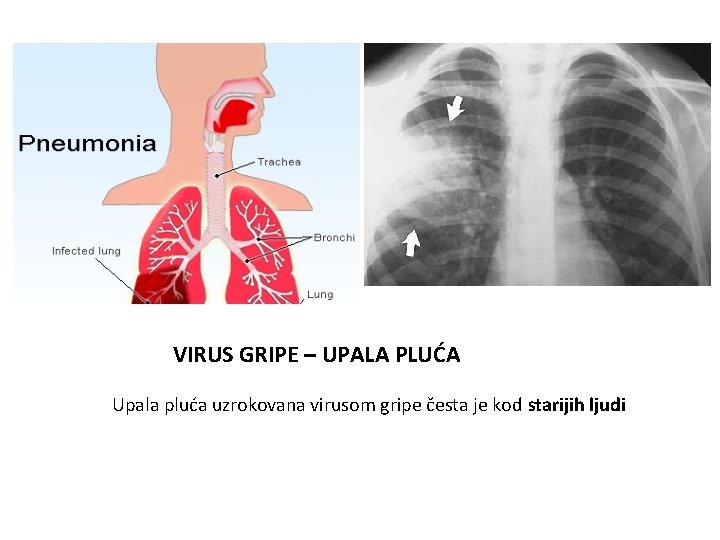 VIRUS GRIPE – UPALA PLUĆA Upala pluća uzrokovana virusom gripe česta je kod starijih