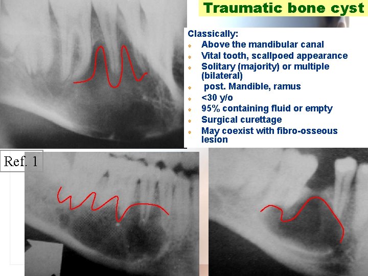 Traumatic bone cyst Classically: | Above the mandibular canal | Vital tooth, scallpoed appearance