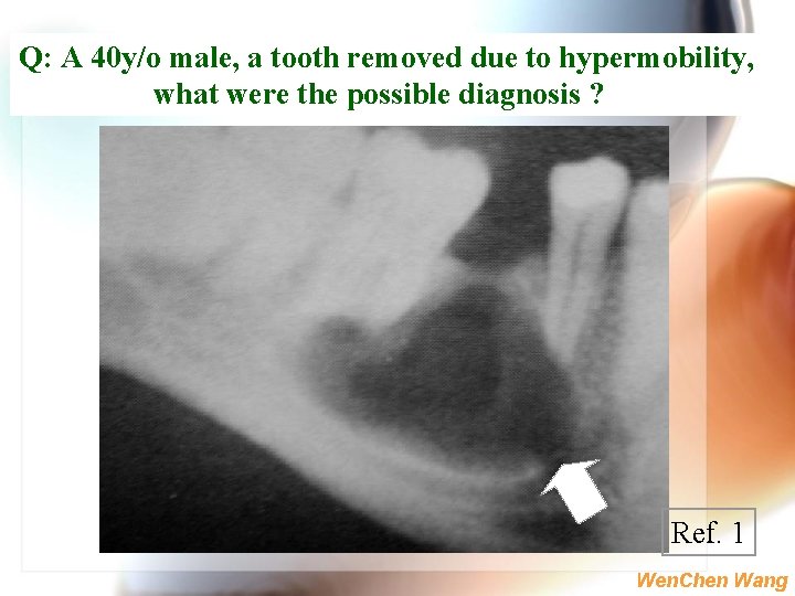 Q: A 40 y/o male, a tooth removed due to hypermobility, what were the