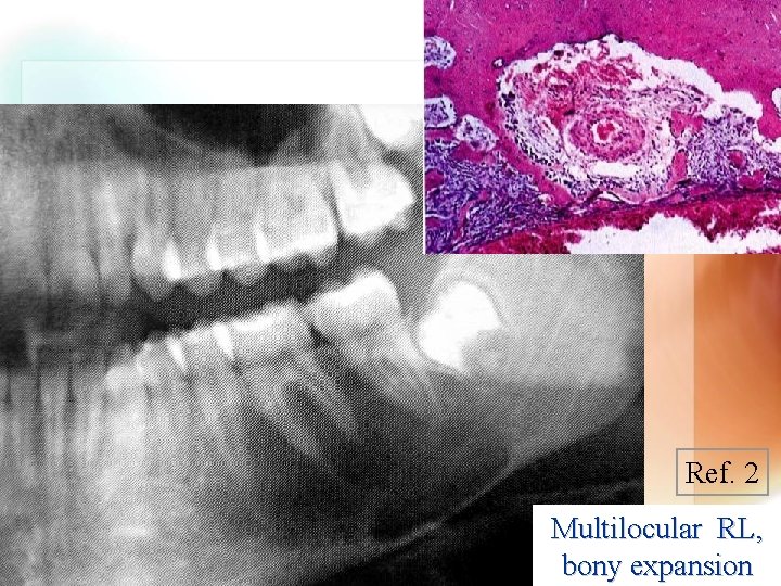 Ref. 2 Multilocular RL, bony Wen. Chen expansion Wang 