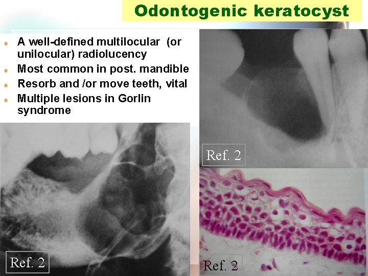 Odontogenic keratocyst | | A well-defined multilocular (or unilocular) radiolucency Most common in post.