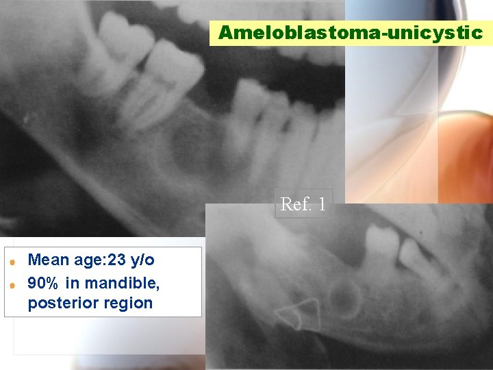 Ameloblastoma-unicystic Ref. 1 | | Mean age: 23 y/o 90% in mandible, posterior region